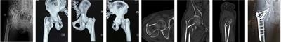 Traction-bed-assisted reduction and double-plate fixation for treatment of comminuted femoral intertrochanteric fractures with coronal split